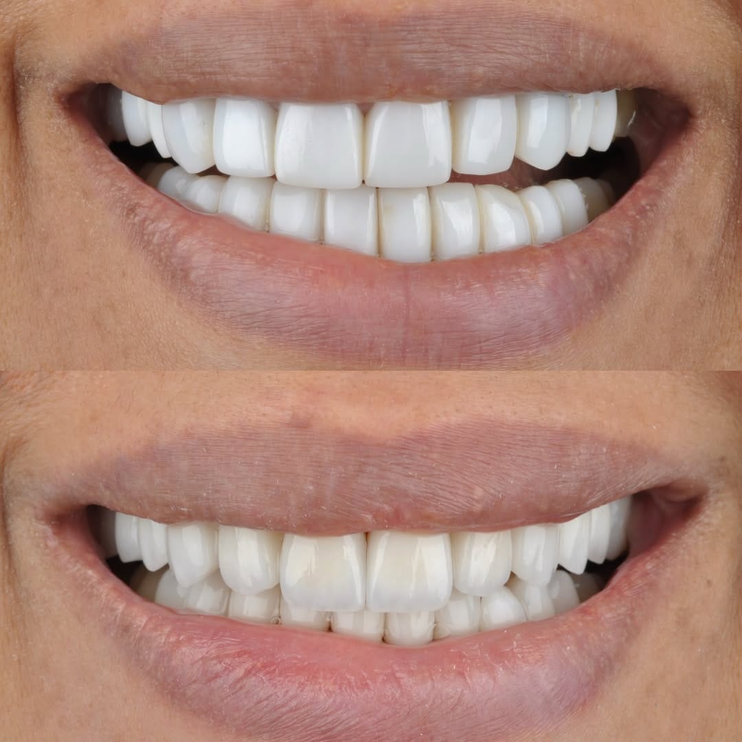 Post 6 by Dr Ahmad zebari implants & cosmetic د أحمد زيباري زراعة و تجميل on Instagram (image)