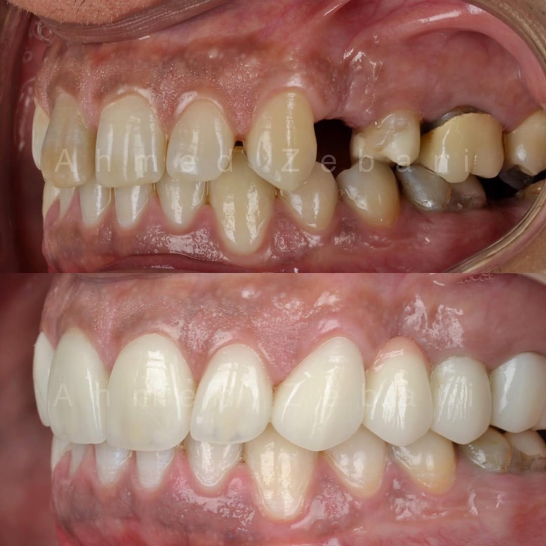 Post 10 by Dr Ahmad zebari implants & cosmetic د أحمد زيباري زراعة و تجميل on Instagram (image)