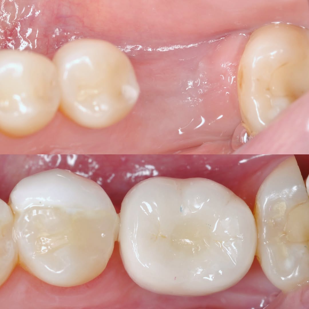 Post 2 by Dr Ahmad zebari implants & cosmetic د أحمد زيباري زراعة و تجميل on Instagram (image)