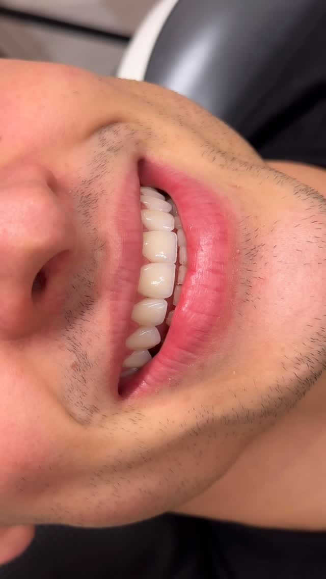 Post 9 by Dr. Batuhan Ünlüler , DDS on Instagram (video)
