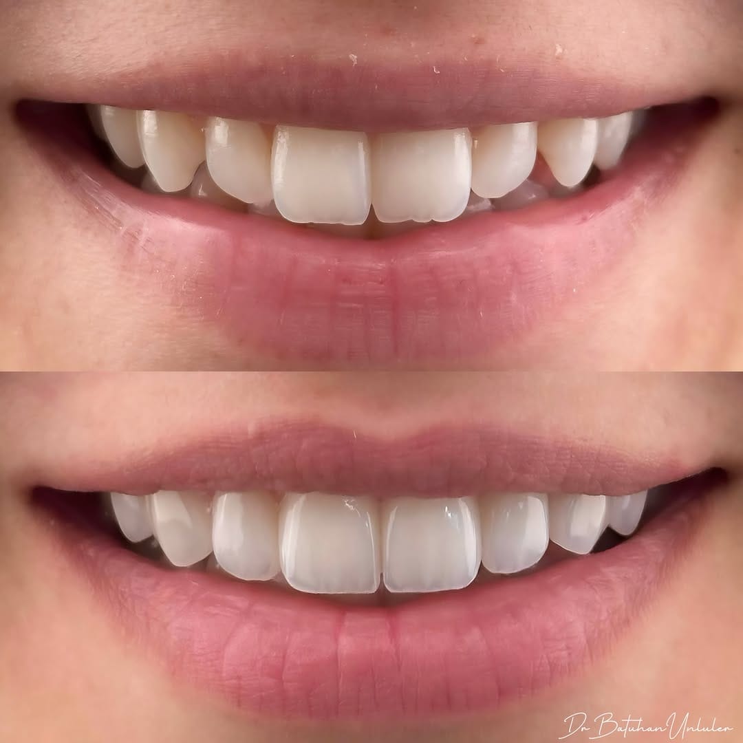 Post 6 by Dr. Batuhan Ünlüler , DDS on Instagram (image)