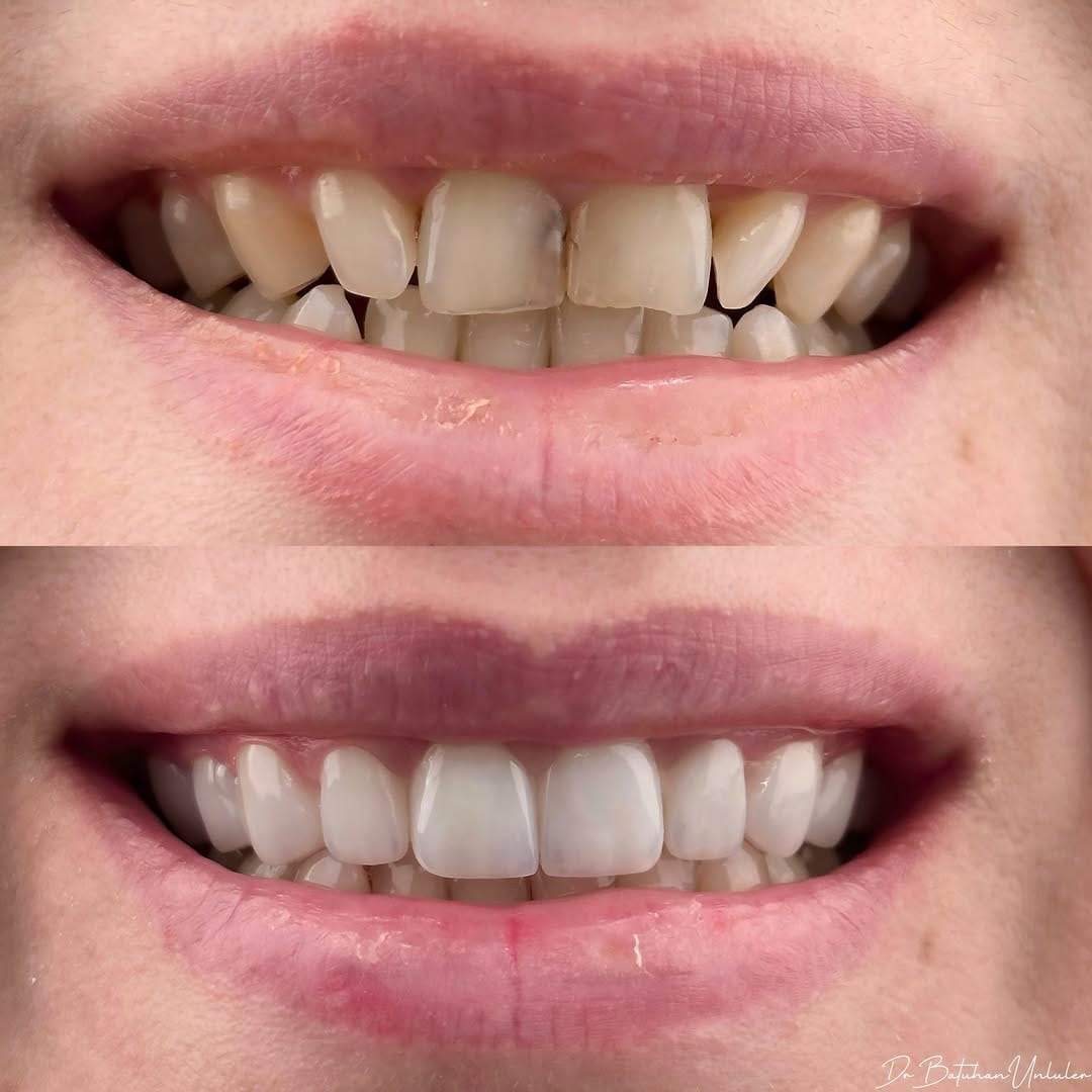 Post 5 by Dr. Batuhan Ünlüler , DDS on Instagram (image)