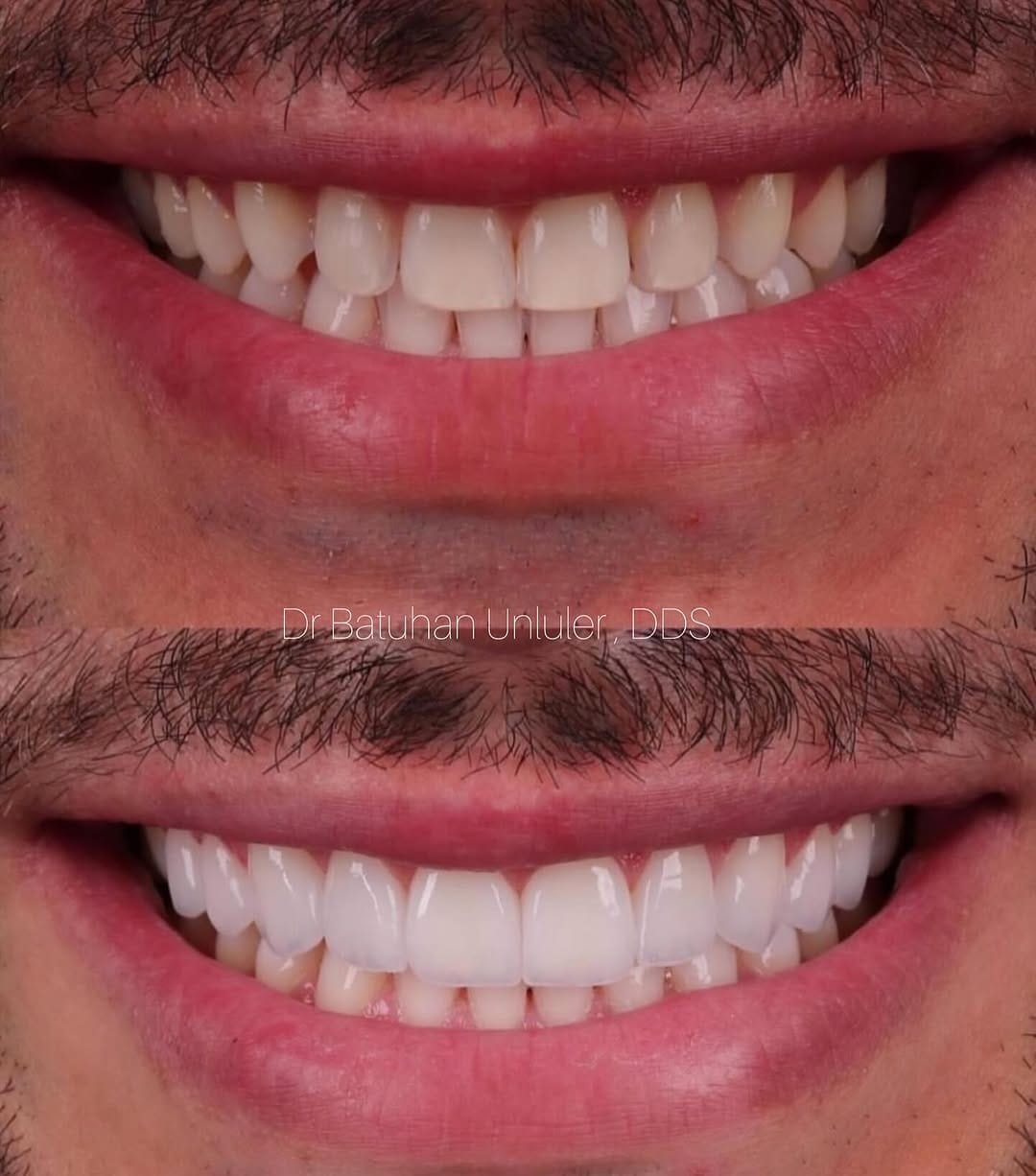 Post 10 by Dr. Batuhan Ünlüler , DDS on Instagram (image)