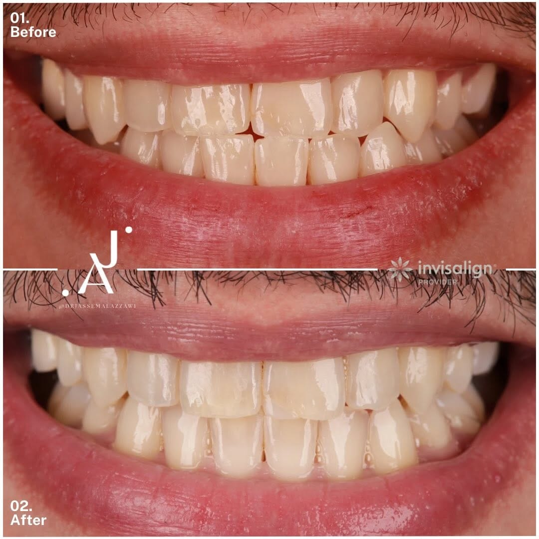 Post 5 by Dr. Jassem Al Azzawi | Anti-Aging | Invisalign | Veneers on Instagram (carousel)