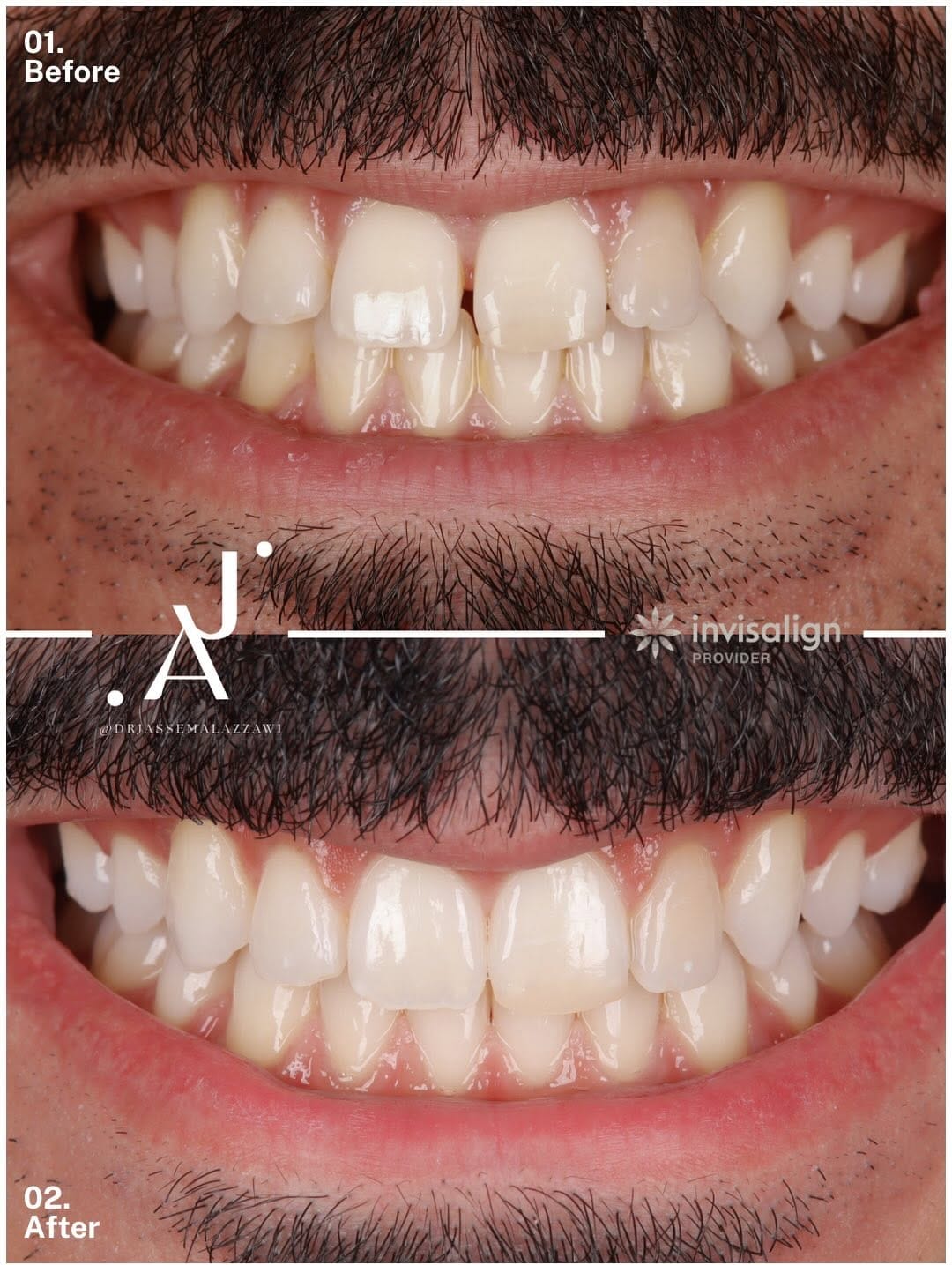 Post 2 by Dr. Jassem Al Azzawi | Anti-Aging | Invisalign | Veneers on Instagram (carousel)