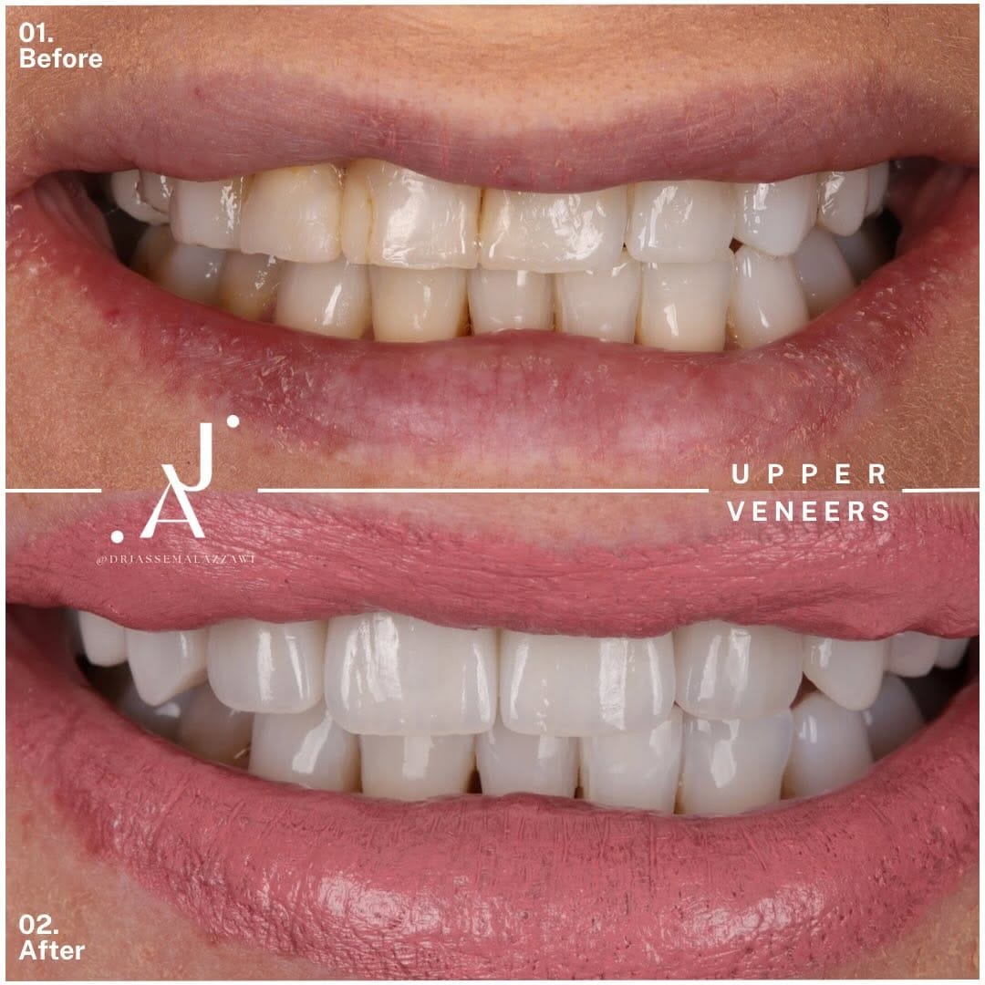 Post 6 by Dr. Jassem Al Azzawi | Anti-Aging | Invisalign | Veneers on Instagram (carousel)