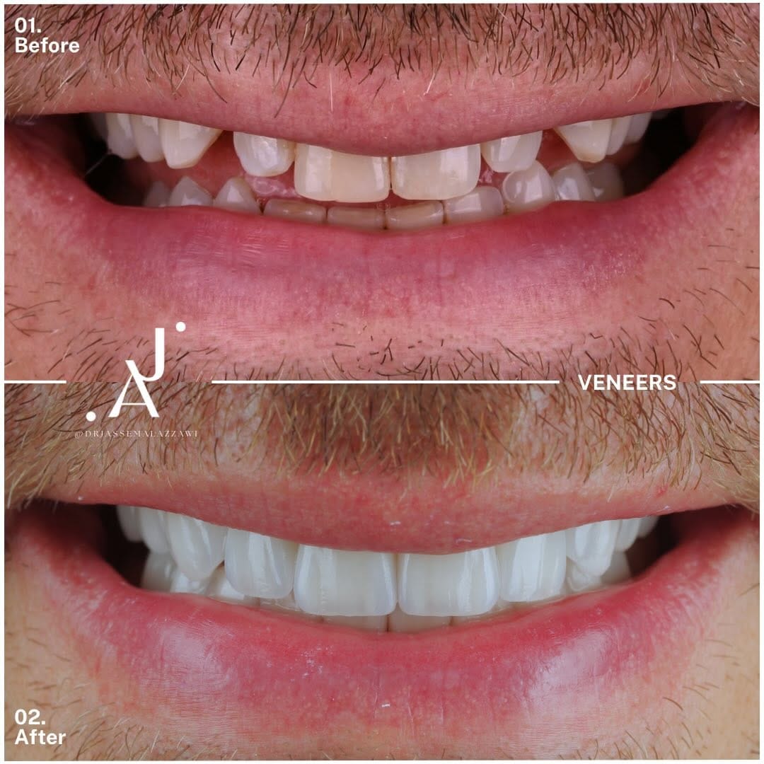 Post 3 by Dr. Jassem Al Azzawi | Anti-Aging | Invisalign | Veneers on Instagram (carousel)