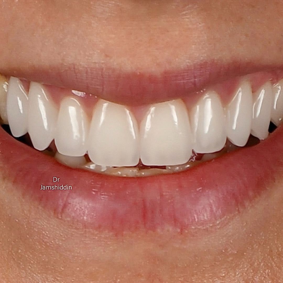 Post 5 by Dr Jamshiddin Dubai Dentist on Instagram (carousel)