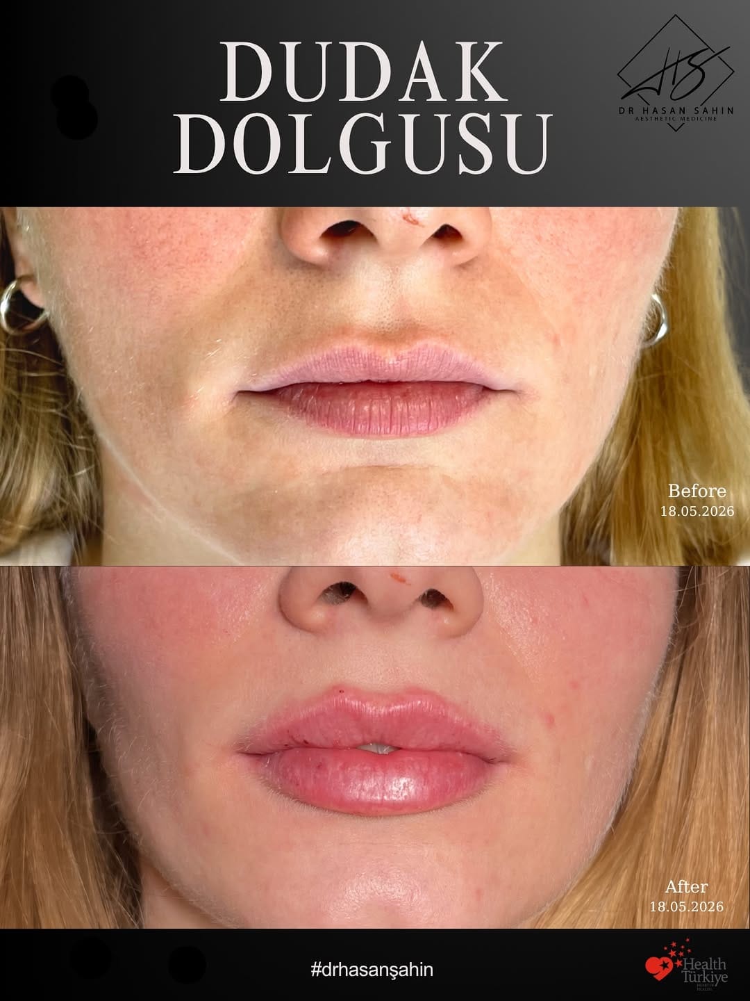 Post 1 by Dr Hasan Şahin ✨ Medikal Estetik ✨ Antiaging on Instagram (image)