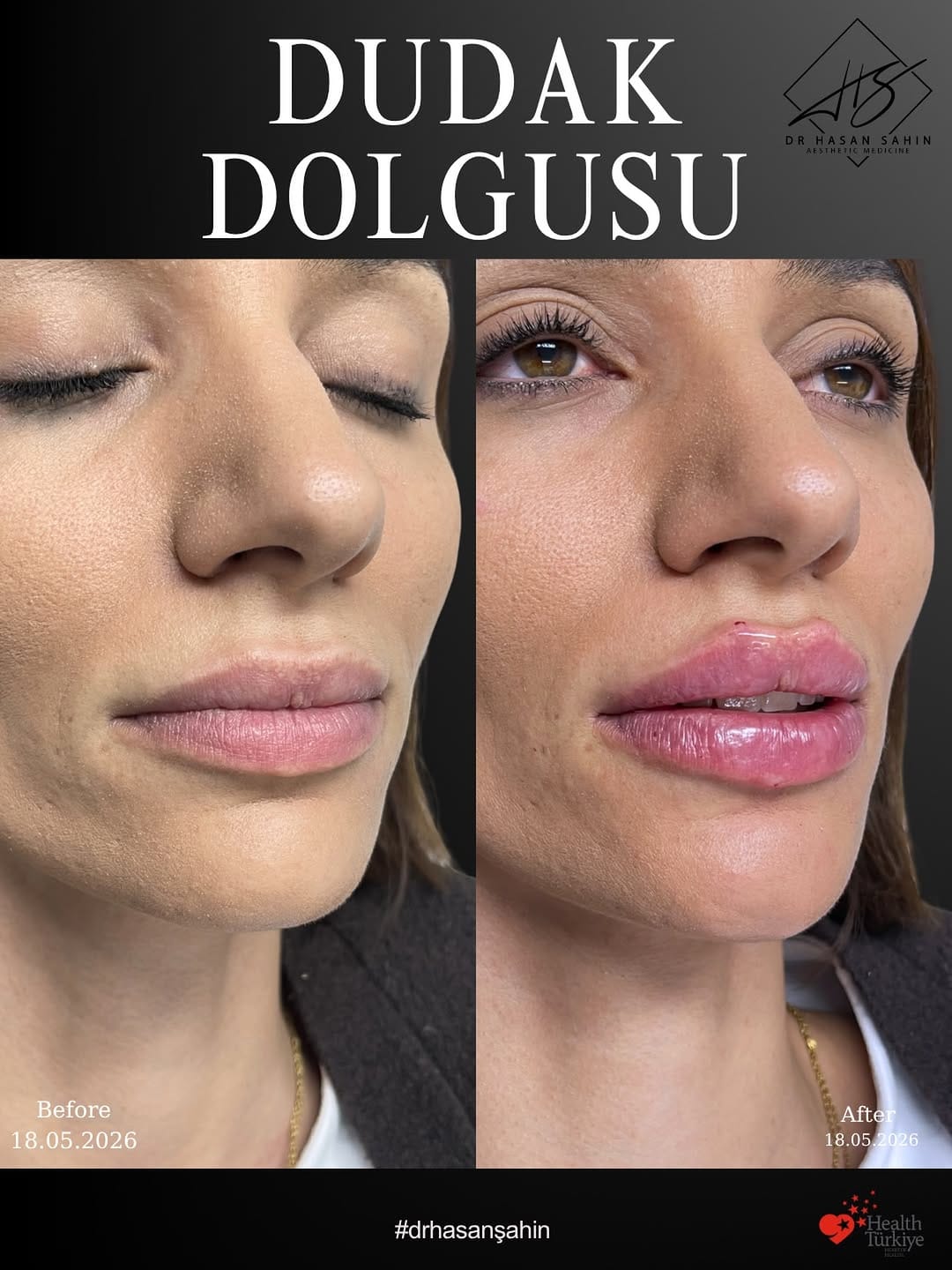 Post 6 by Dr Hasan Şahin ✨ Medikal Estetik ✨ Antiaging on Instagram (image)
