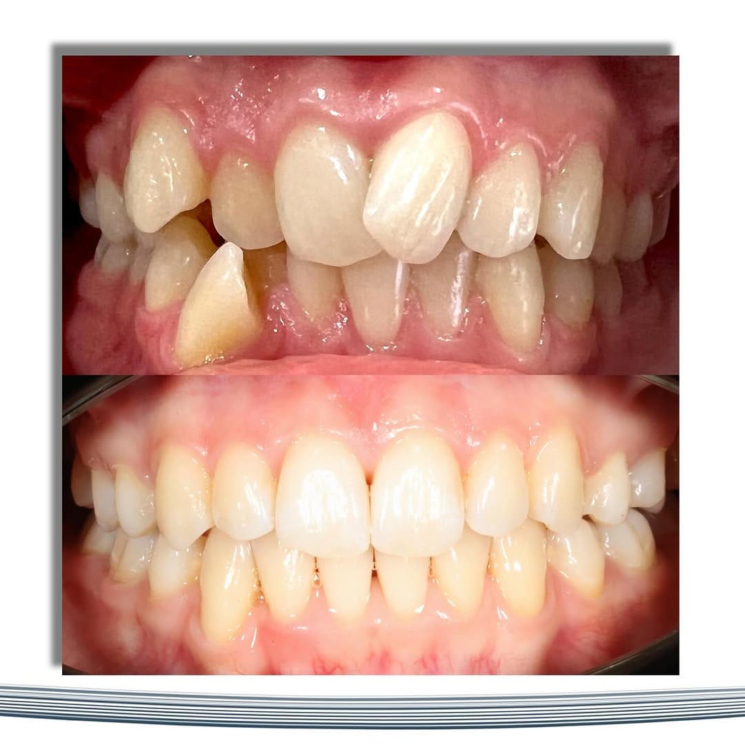 Post 2 by 𝙳𝚛. 𝙼𝚊𝚔𝚜𝚞𝚝 𝙱𝚎𝚑𝚛𝚞𝚣𝚘𝚐𝚕𝚞 Orthodontist / Ортодонт on Instagram (image)