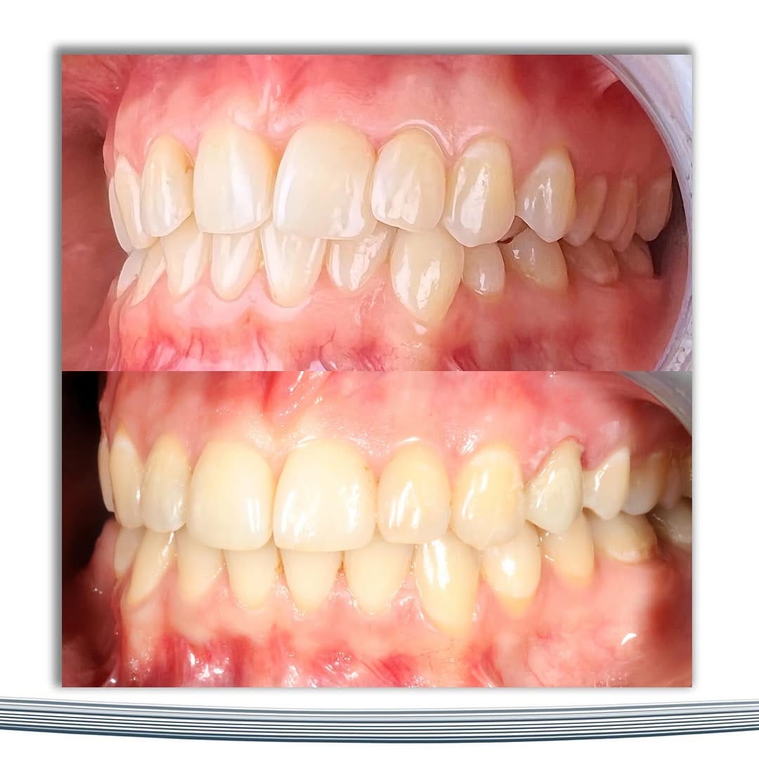 Post 5 by 𝙳𝚛. 𝙼𝚊𝚔𝚜𝚞𝚝 𝙱𝚎𝚑𝚛𝚞𝚣𝚘𝚐𝚕𝚞 Orthodontist / Ортодонт on Instagram (image)