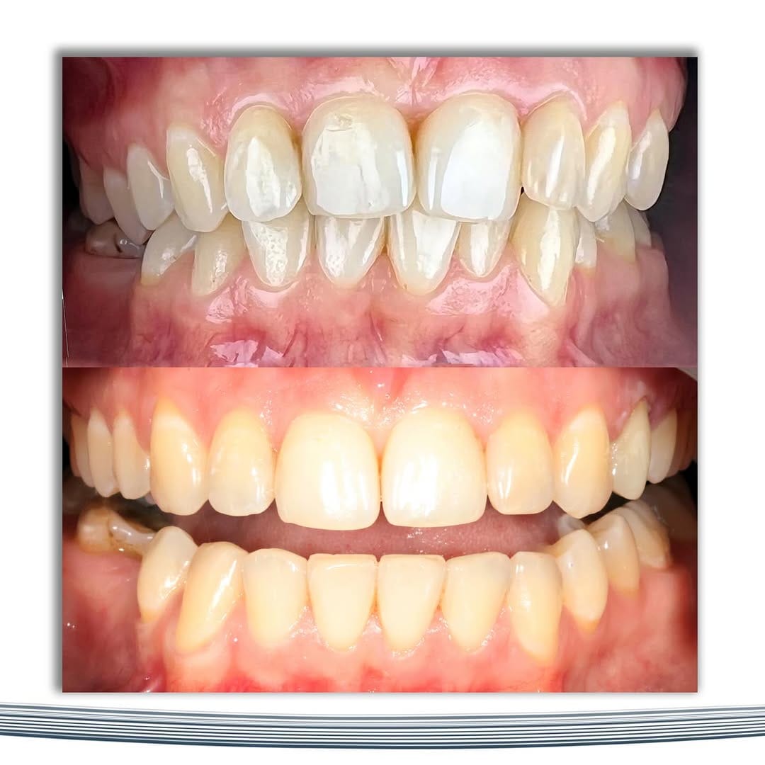 Post 8 by 𝙳𝚛. 𝙼𝚊𝚔𝚜𝚞𝚝 𝙱𝚎𝚑𝚛𝚞𝚣𝚘𝚐𝚕𝚞 Orthodontist / Ортодонт on Instagram (image)