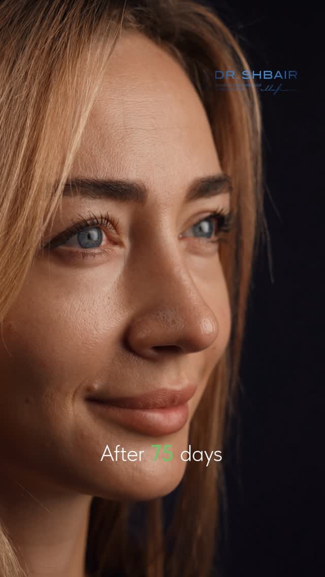 Post 3 by RHINOPLASTY ALMATY | DUBAI on Instagram (video)