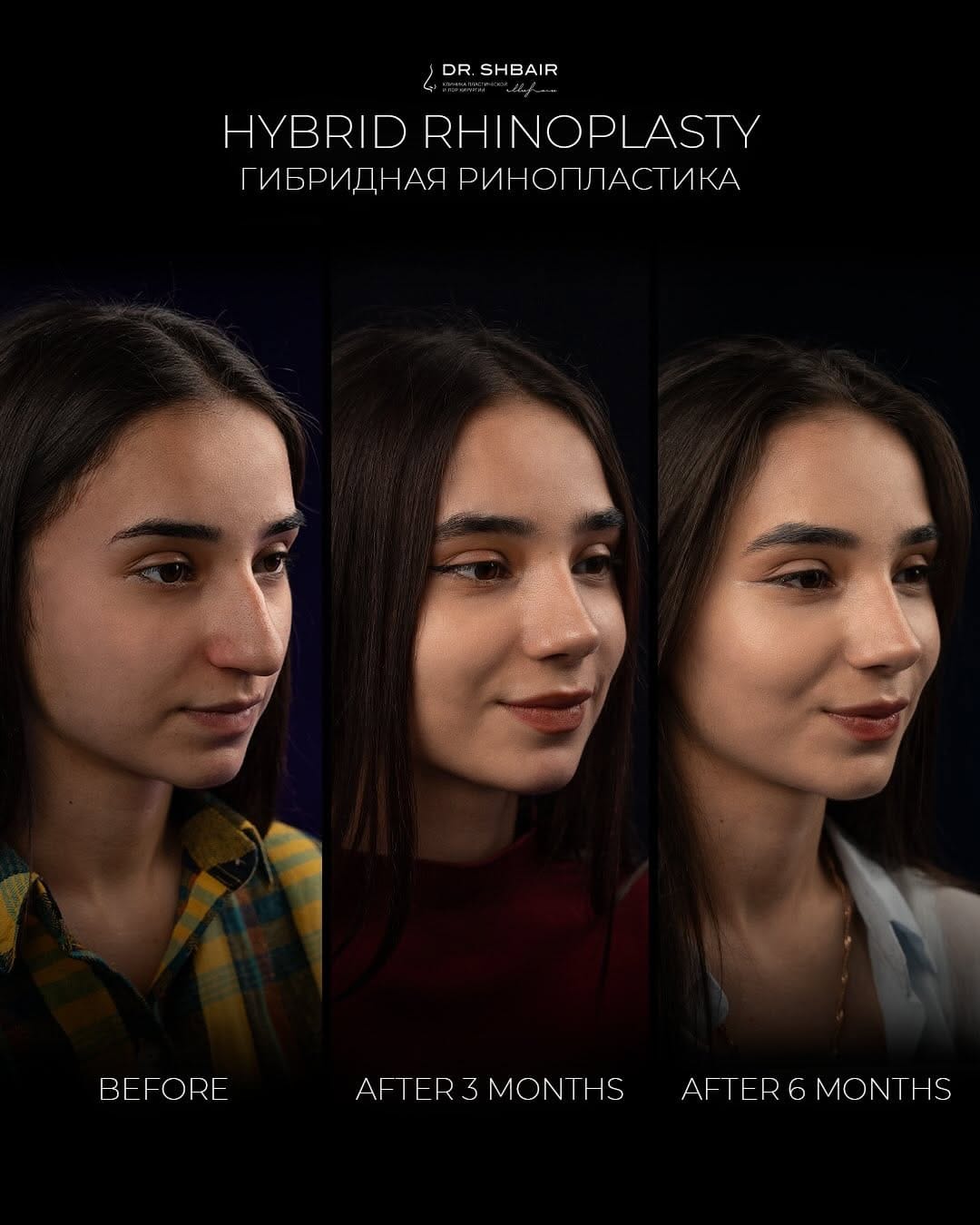 Post 4 by RHINOPLASTY ALMATY | DUBAI on Instagram (carousel)
