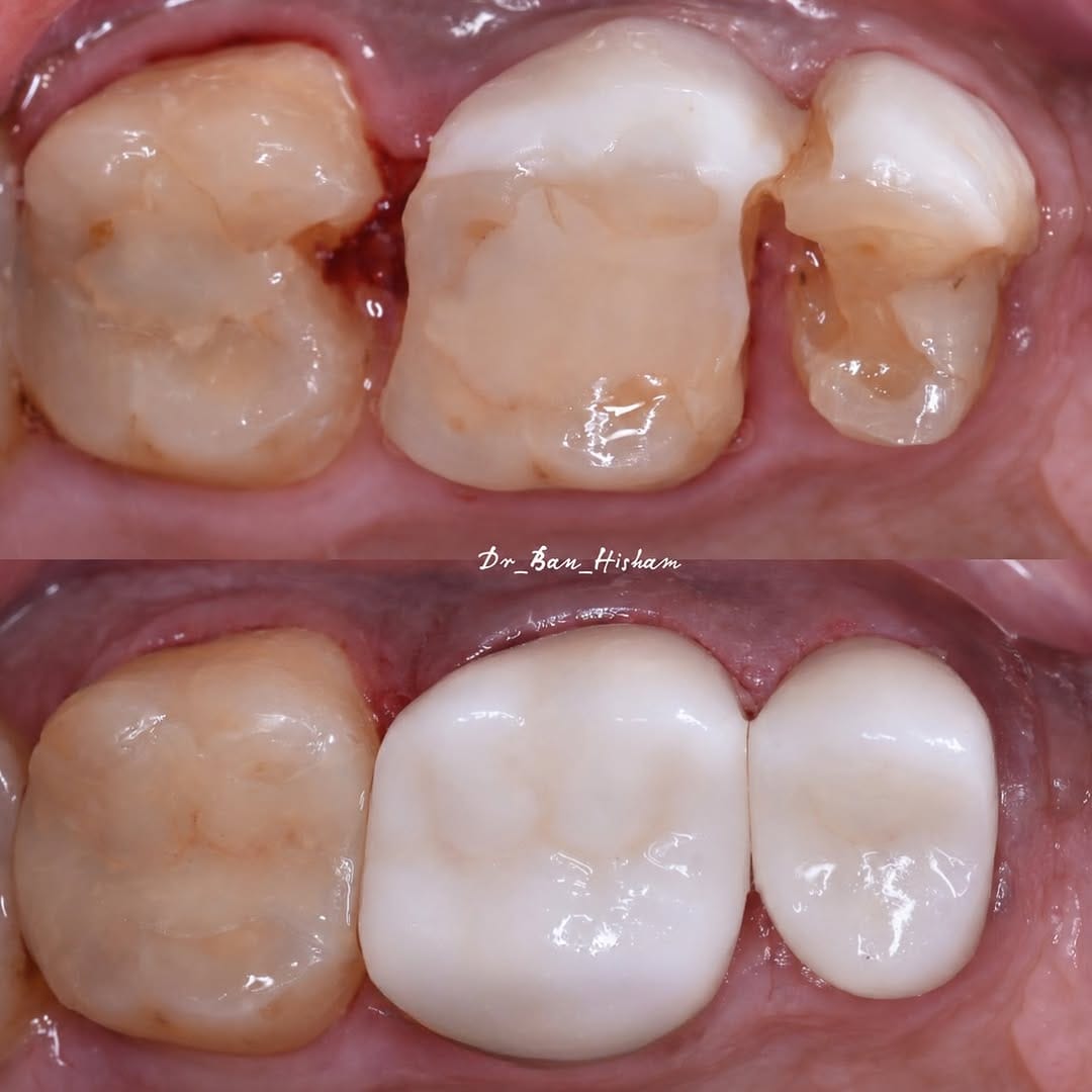 Post 1 by Dr.Ban Al Mishhadani | Dentist - طبيبة أسنان 🦷 on Instagram (image)