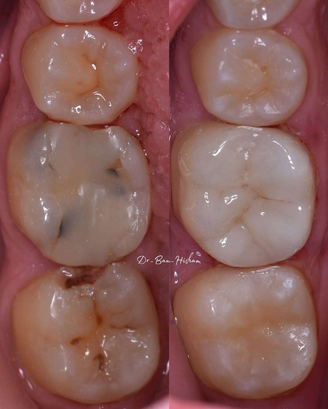 Post 6 by Dr.Ban Al Mishhadani | Dentist - طبيبة أسنان 🦷 on Instagram (carousel)