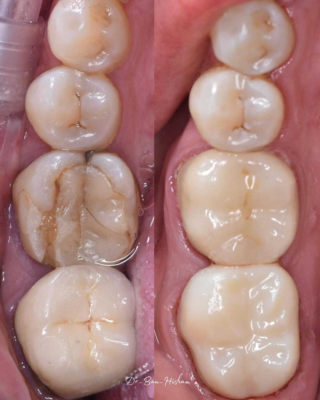 Post 8 by Dr.Ban Al Mishhadani | Dentist - طبيبة أسنان 🦷 on Instagram (carousel)