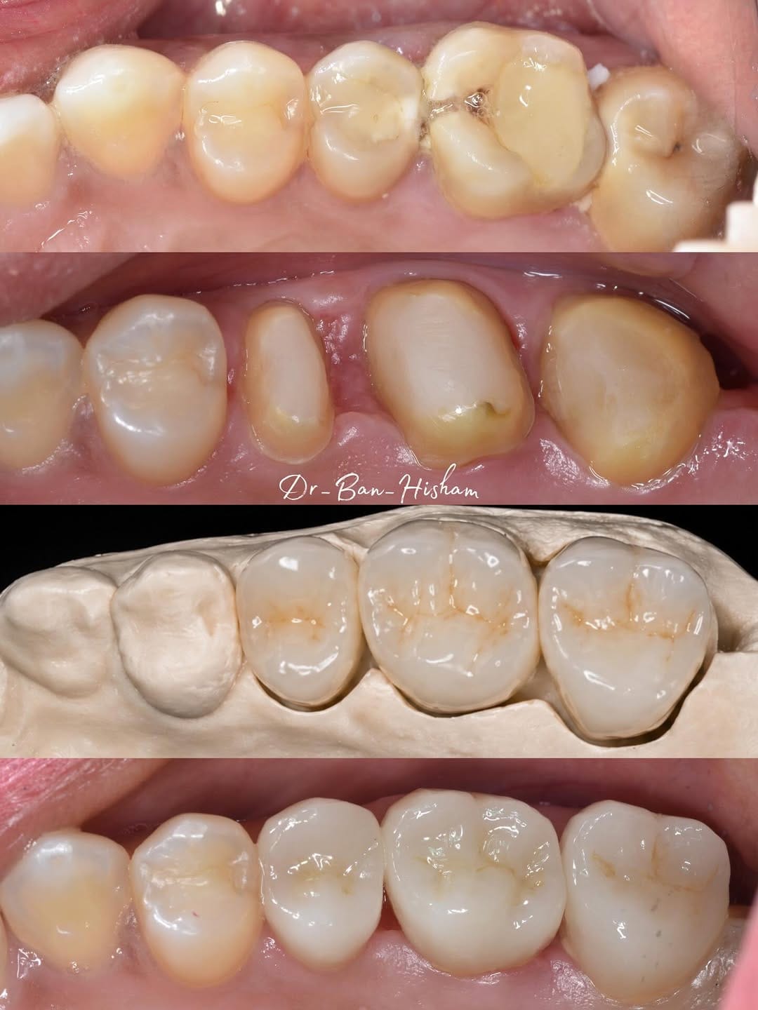 Post 9 by Dr.Ban Al Mishhadani | Dentist - طبيبة أسنان 🦷 on Instagram (carousel)