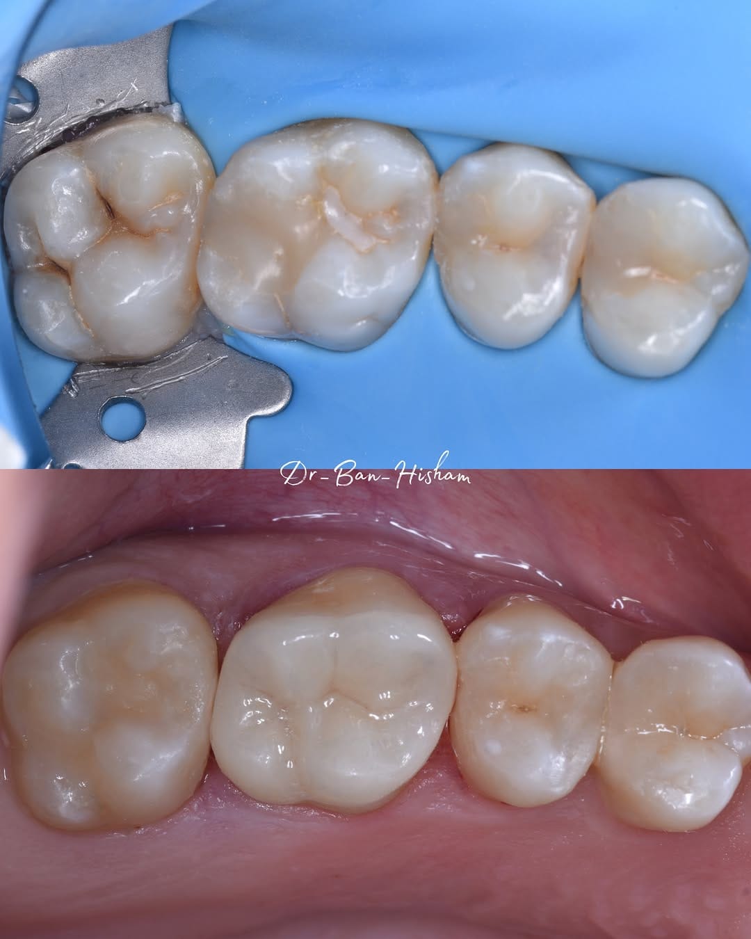 Post 4 by Dr.Ban Al Mishhadani | Dentist - طبيبة أسنان 🦷 on Instagram (carousel)