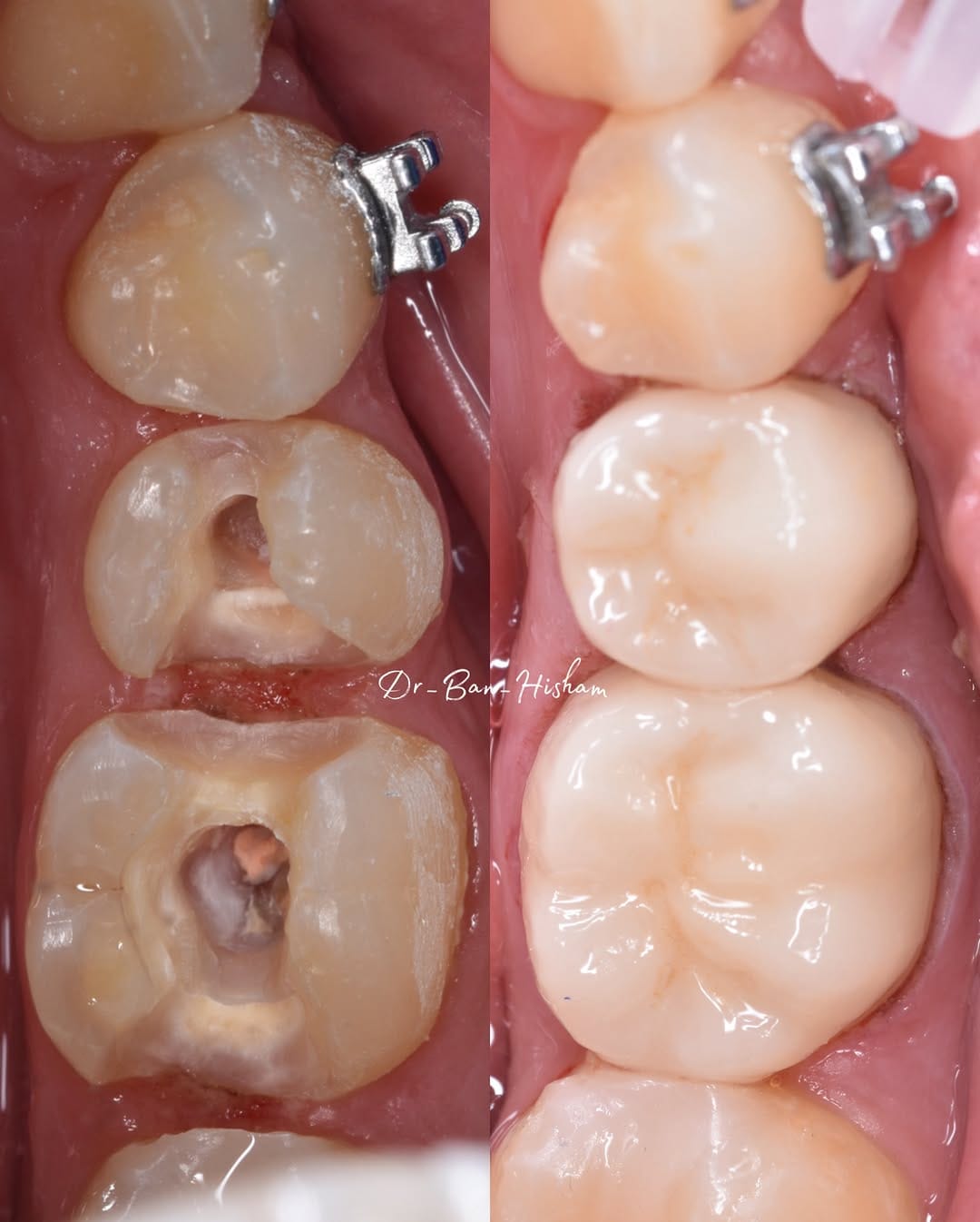 Post 2 by Dr.Ban Al Mishhadani | Dentist - طبيبة أسنان 🦷 on Instagram (carousel)