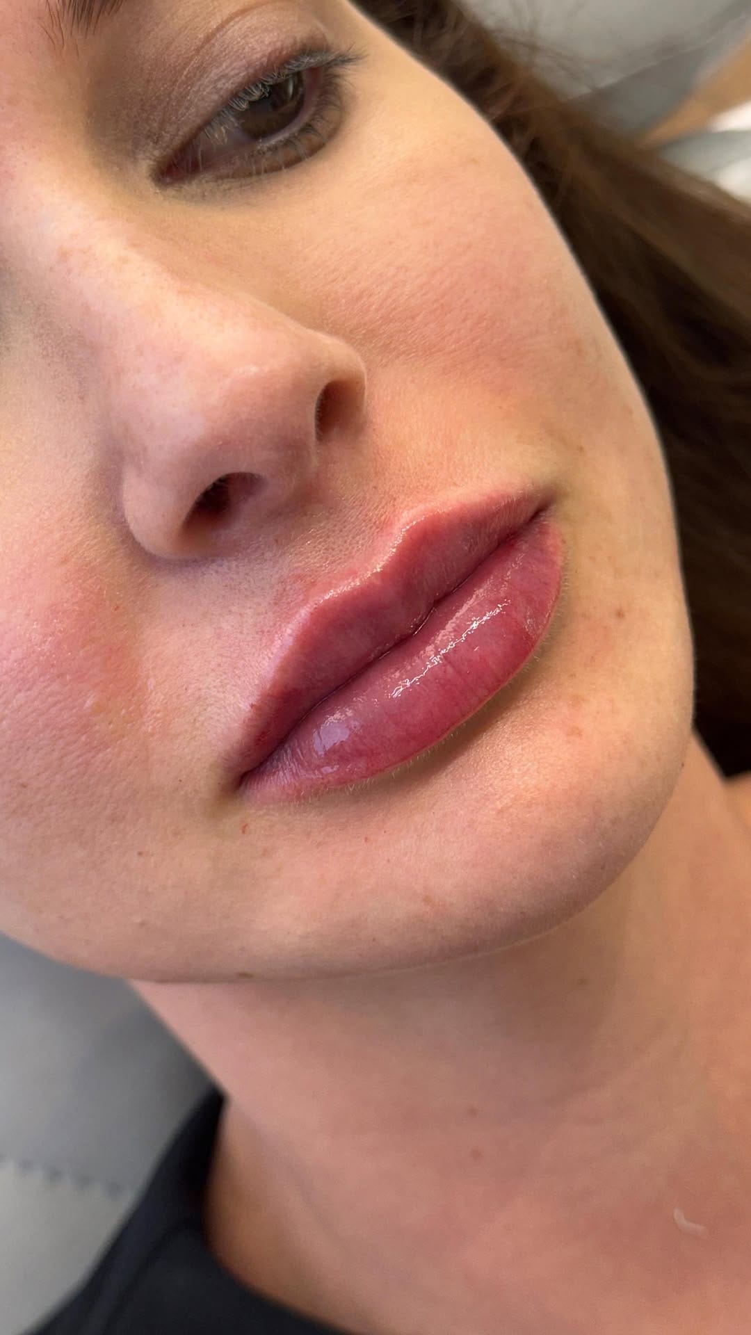 Post 8 by Dra. Júlia Sandes | Harmonização Facial on Instagram (video)