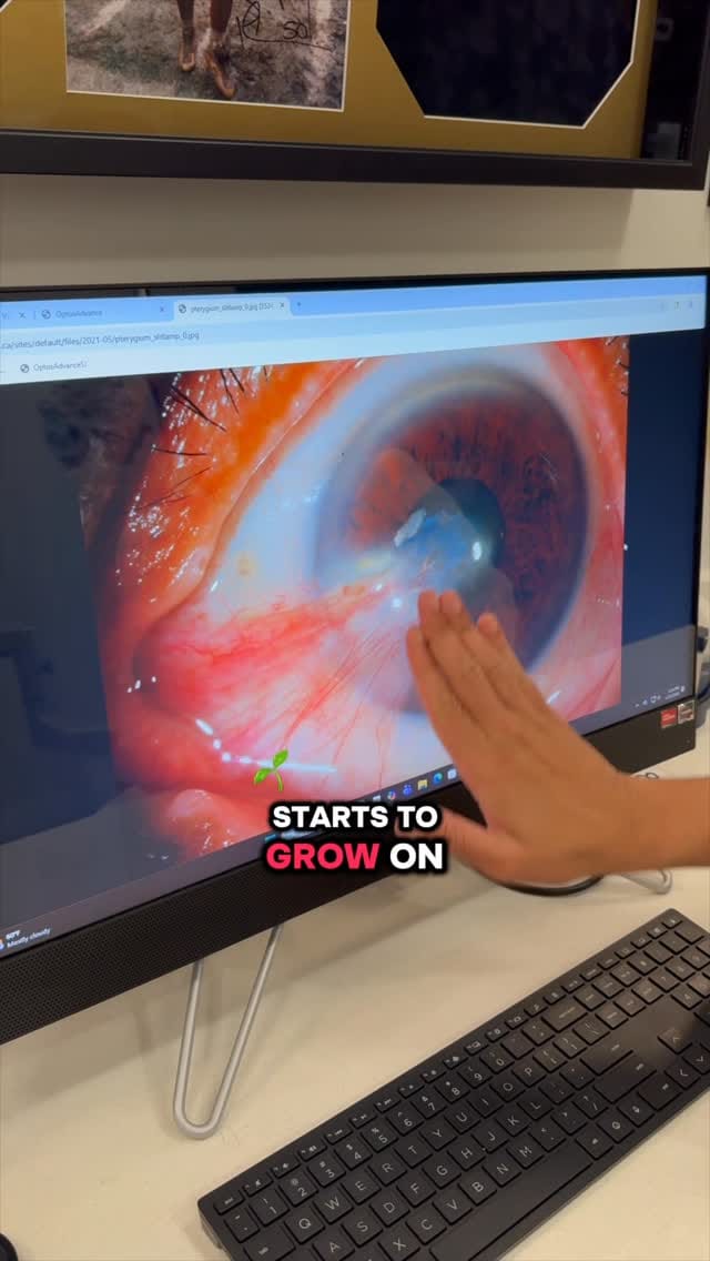 Post 6 by Laser Eye Center Of Silicon Valley on Instagram (video)