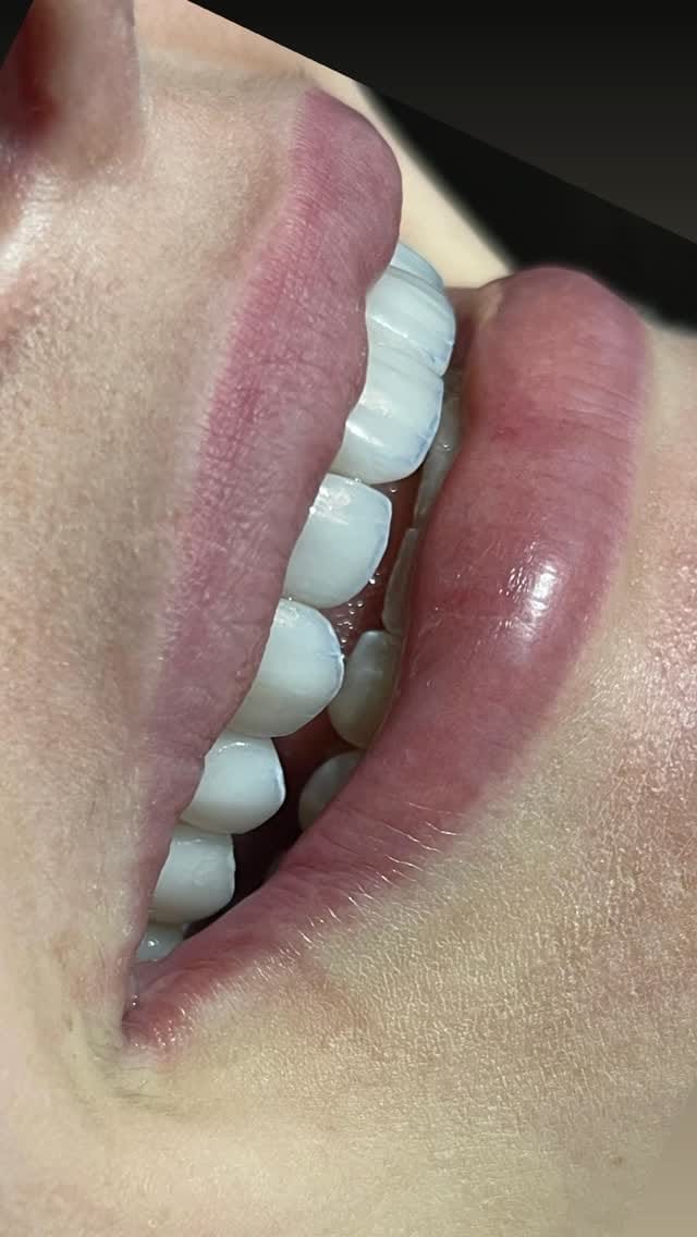 Post 4 by Dr. Glauberton Ricardo •Mimetizar Sorriso e Face on Instagram (video)