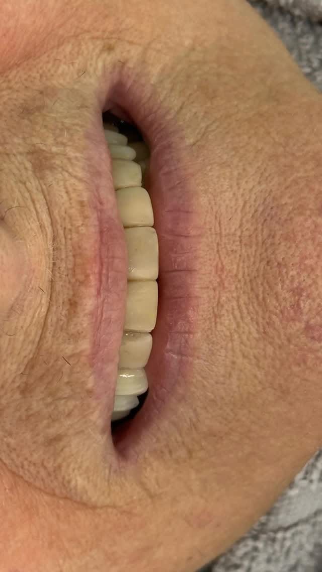 Post 7 by Dr. Glauberton Ricardo •Mimetizar Sorriso e Face on Instagram (video)