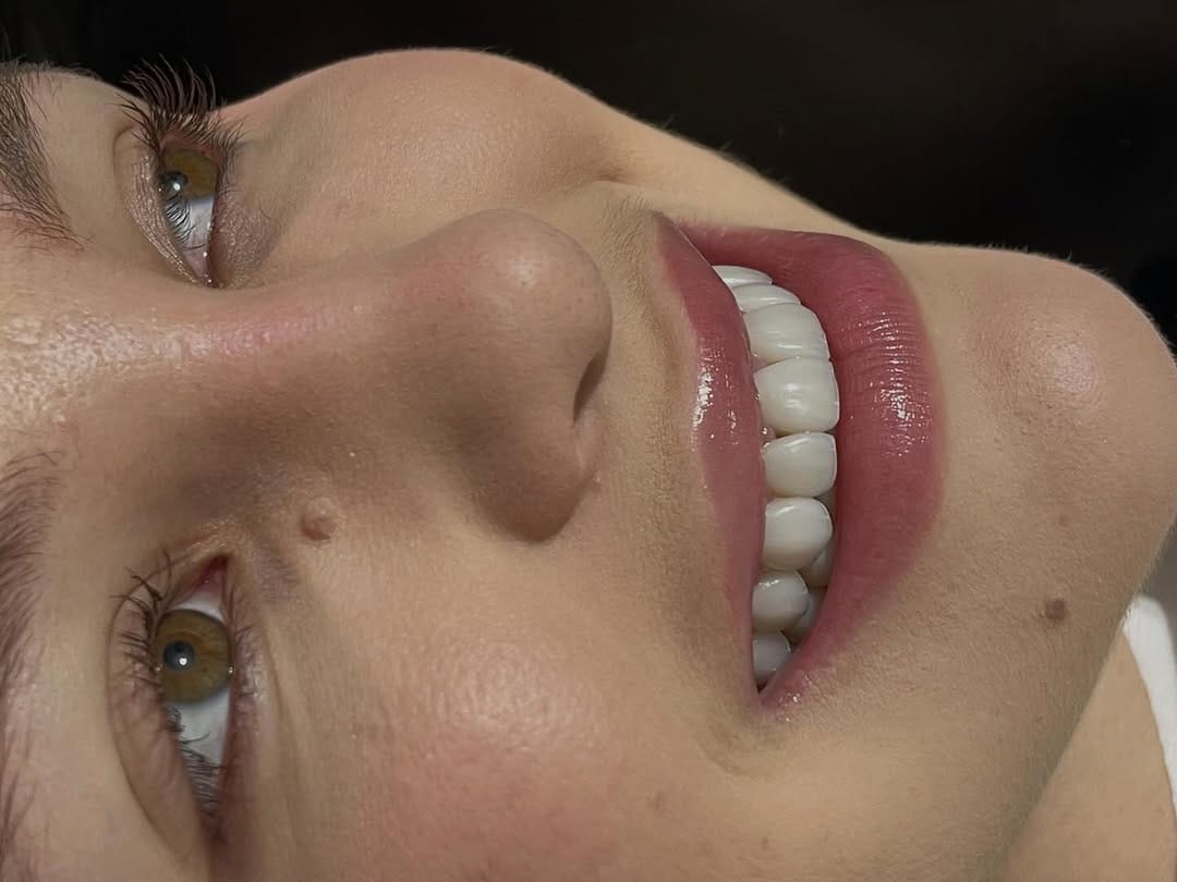 Post 1 by Dr. Glauberton Ricardo •Mimetizar Sorriso e Face on Instagram (image)
