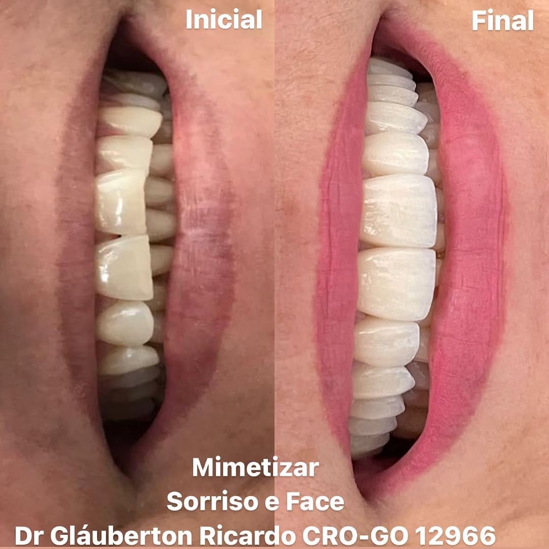 Post 10 by Dr. Glauberton Ricardo •Mimetizar Sorriso e Face on Instagram (image)