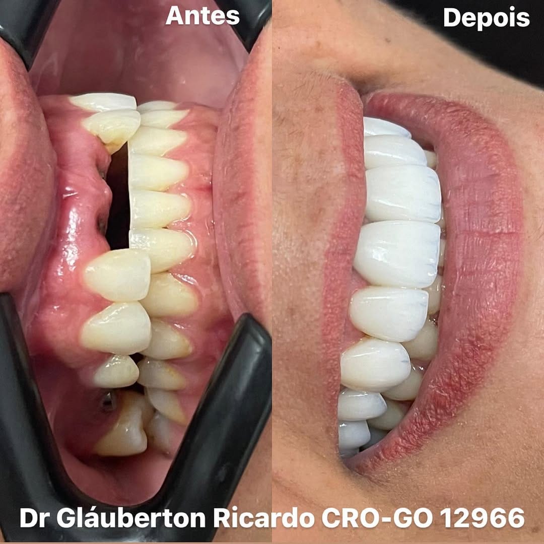 Post 9 by Dr. Glauberton Ricardo •Mimetizar Sorriso e Face on Instagram (carousel)