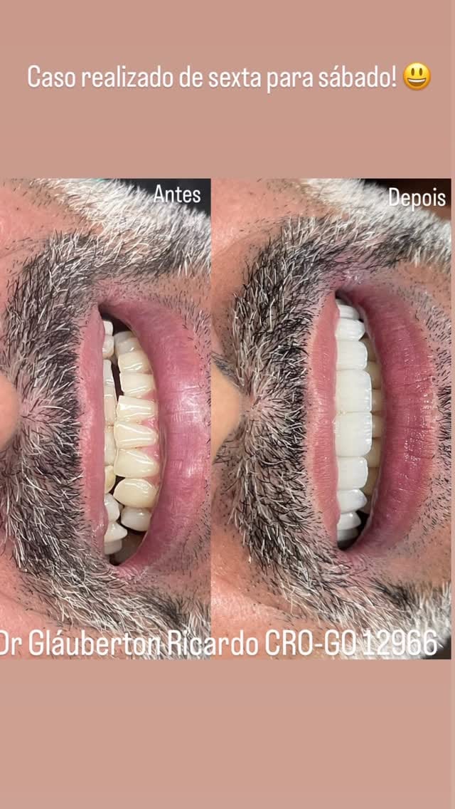 Post 5 by Dr. Glauberton Ricardo •Mimetizar Sorriso e Face on Instagram (video)