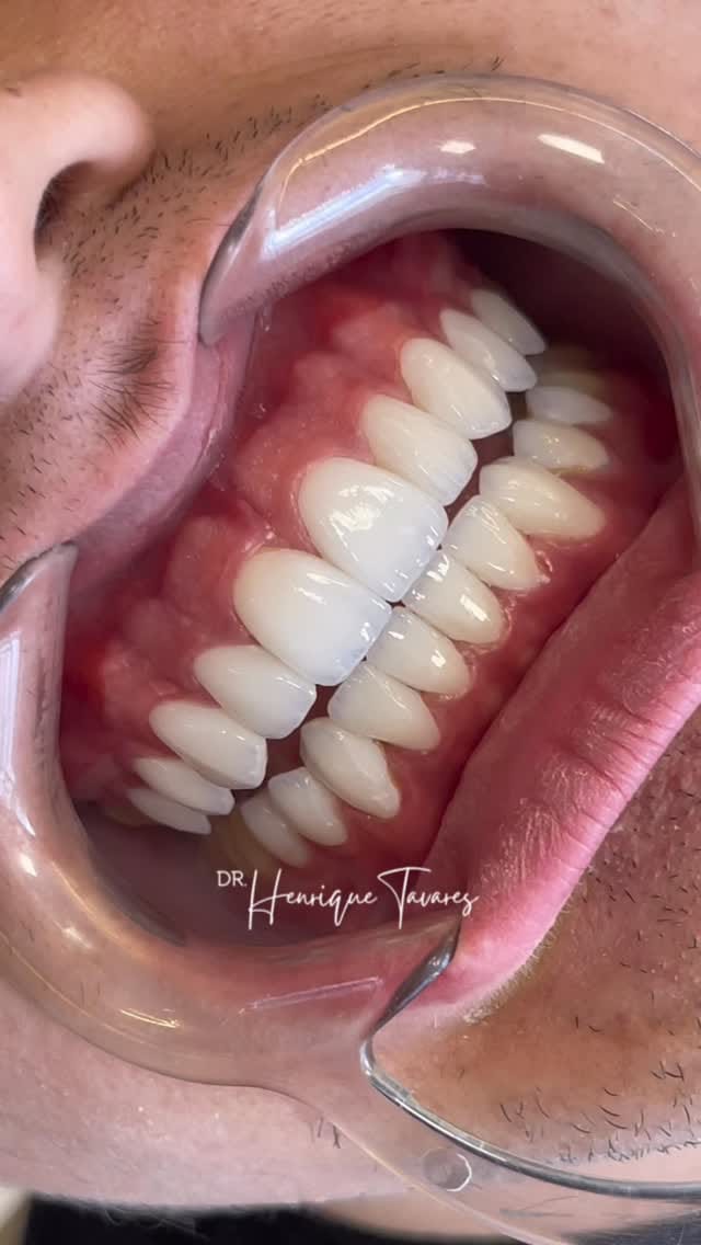 Post 2 by DR. HENRIQUE TAVARES | LENTES EM PORCELANA on Instagram (video)