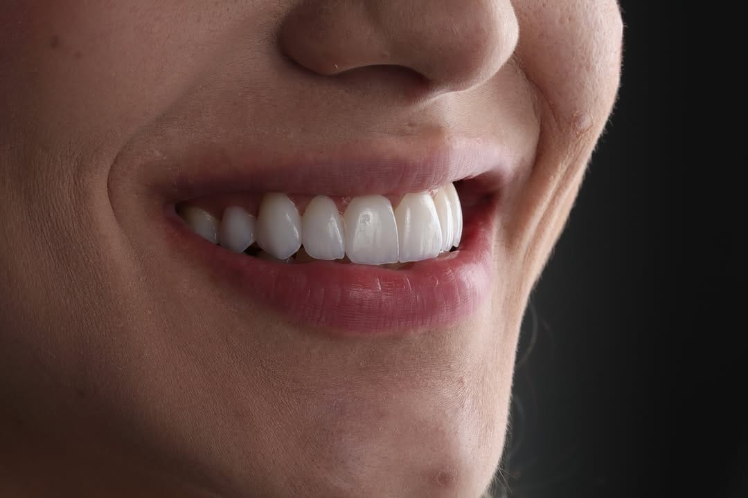 Post 4 by Dr.Edmo Matheus - Odontologia Estética e Implantes 🇧🇷 on Instagram (carousel)