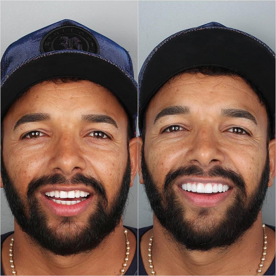 Post 9 by Dr.Edmo Matheus - Odontologia Estética e Implantes 🇧🇷 on Instagram (image)