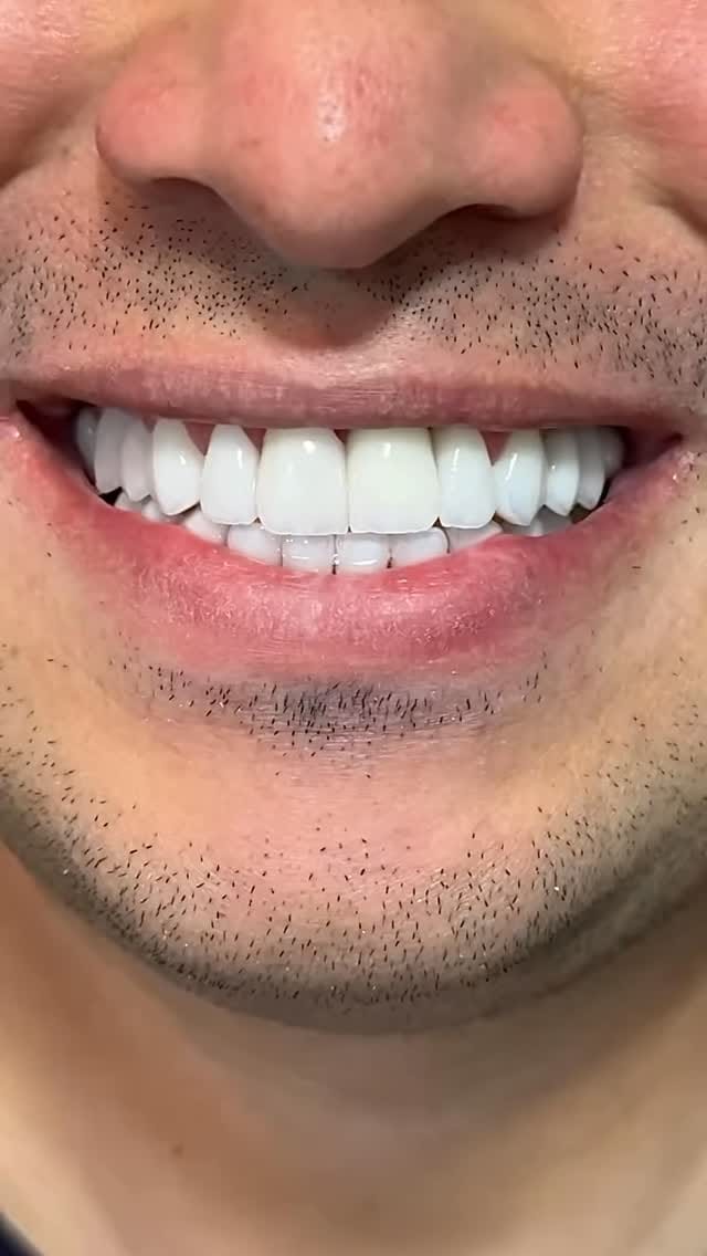 Post 6 by Dr.Edmo Matheus - Odontologia Estética e Implantes 🇧🇷 on Instagram (video)
