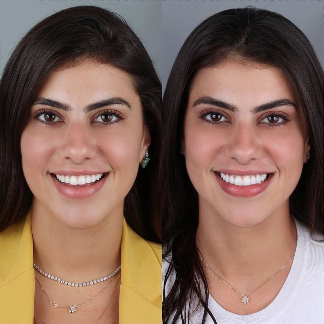 Post 8 by Dr.Edmo Matheus - Odontologia Estética e Implantes 🇧🇷 on Instagram (carousel)