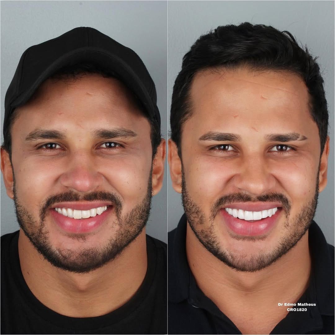 Post 10 by Dr.Edmo Matheus - Odontologia Estética e Implantes 🇧🇷 on Instagram (image)