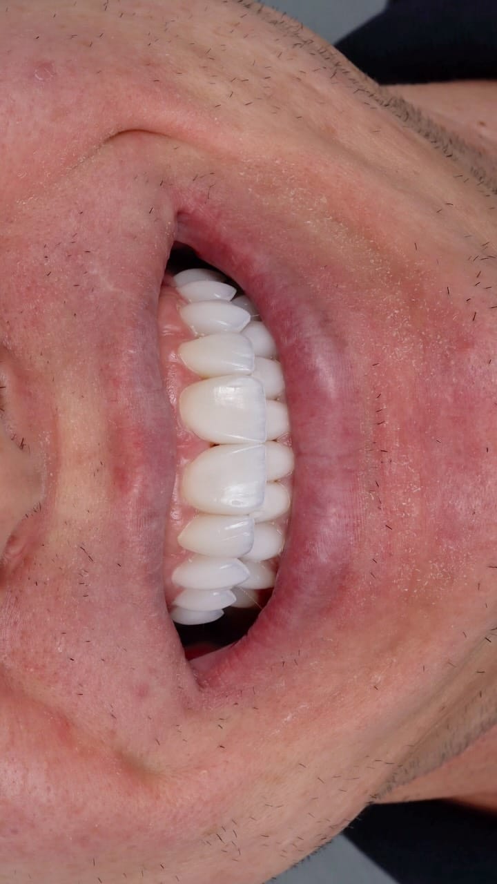 Post 2 by Dr.Edmo Matheus - Odontologia Estética e Implantes 🇧🇷 on Instagram (video)