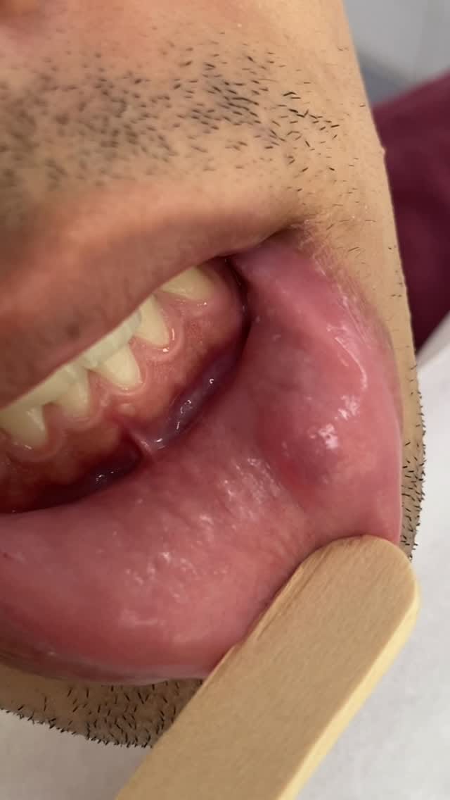 Post 4 by Yuri Medeiros | Estomatologia on Instagram (video)