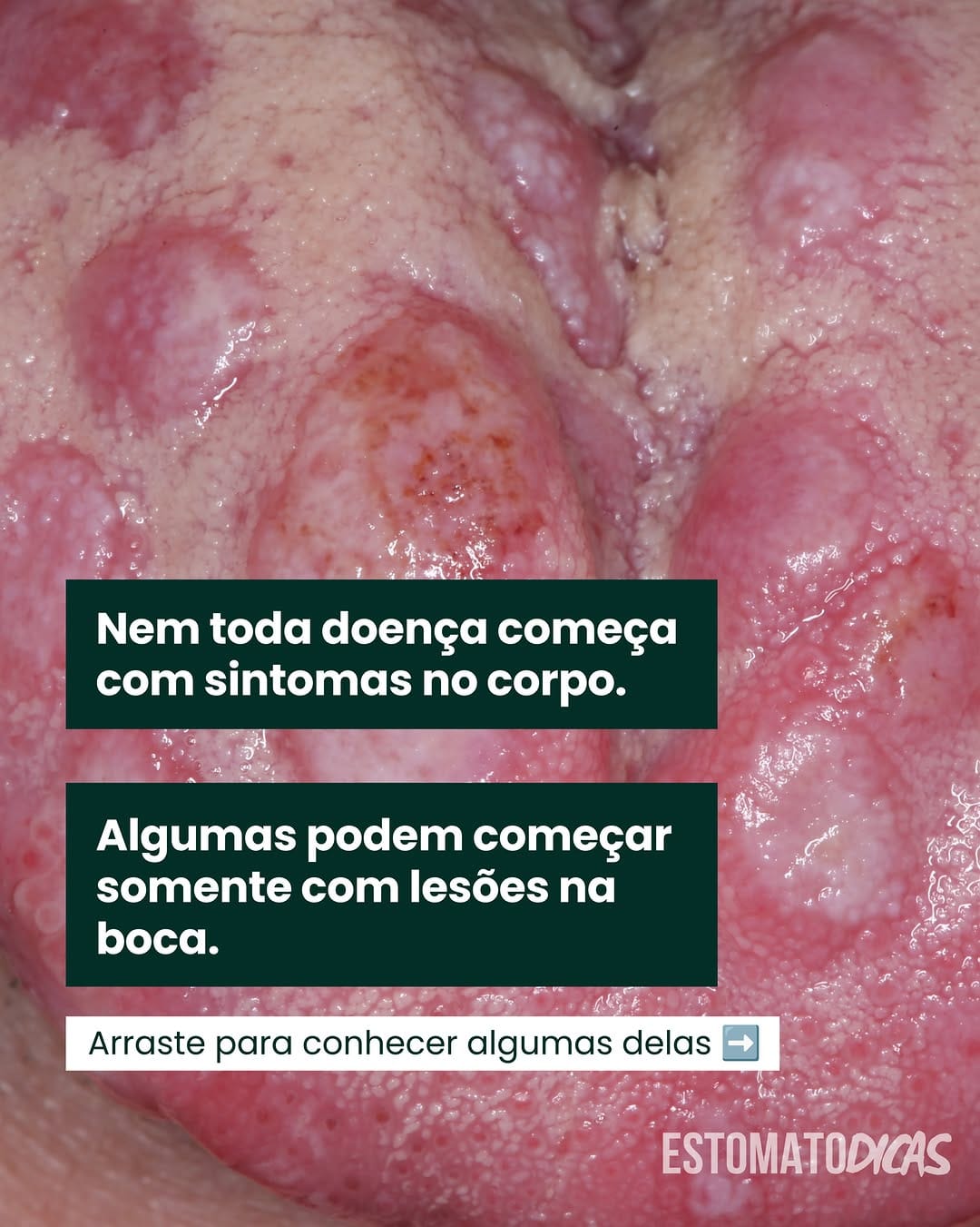 Post 3 by Yuri Medeiros | Estomatologia on Instagram (carousel)