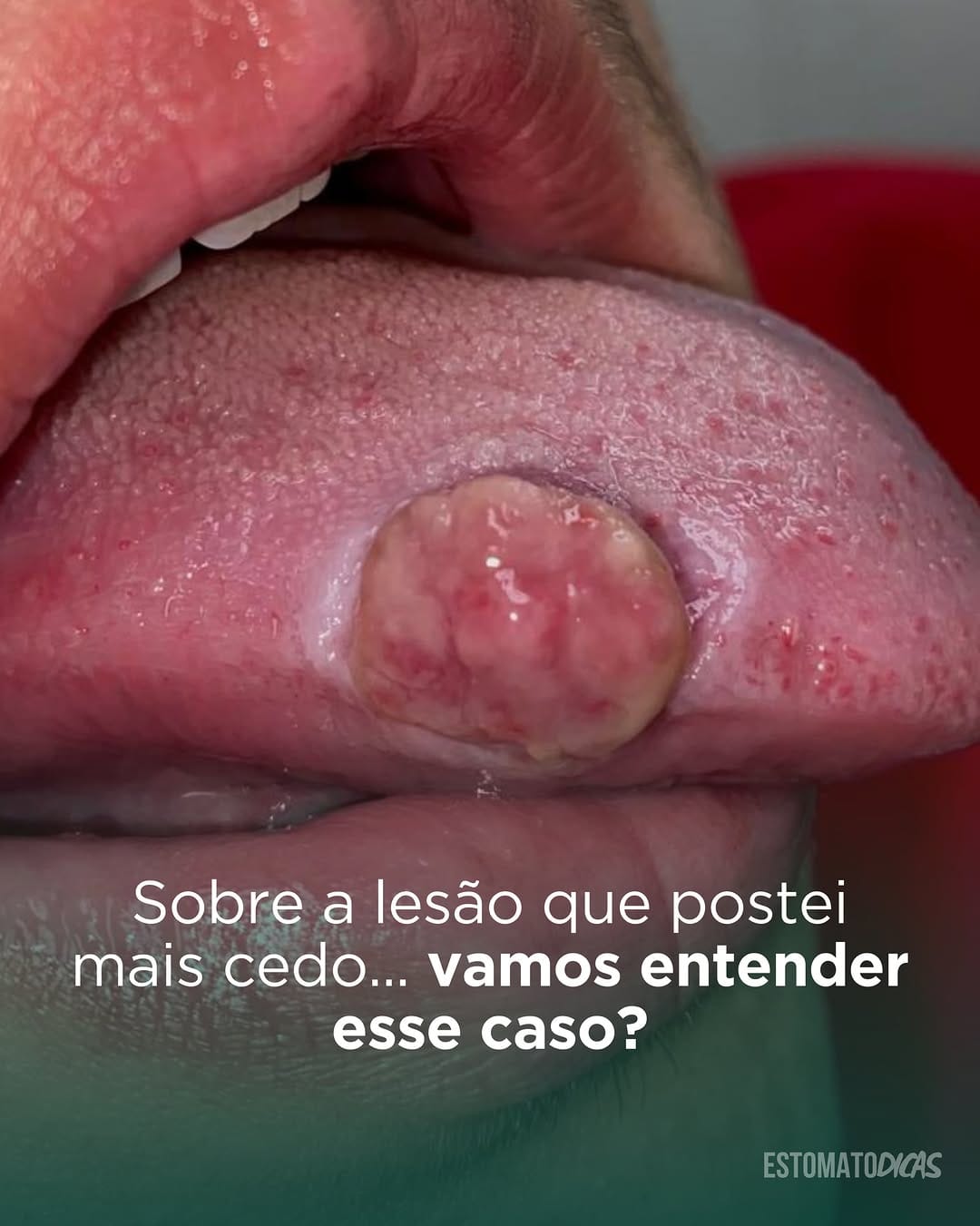 Post 1 by Yuri Medeiros | Estomatologia on Instagram (carousel)