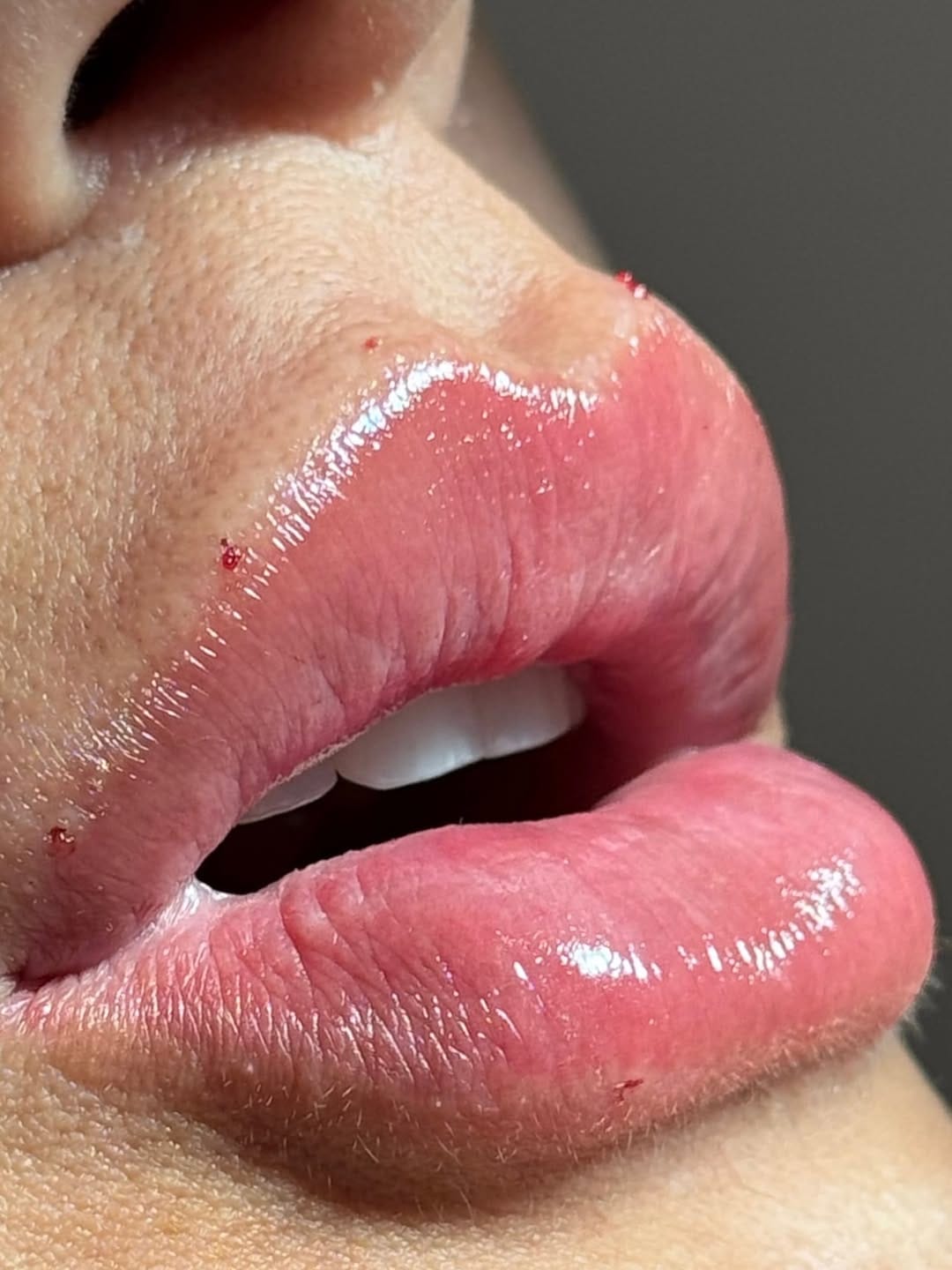 Post 10 by Sheila Amaral-Harmonização Facial | Lentes de Contato Dental on Instagram (carousel)