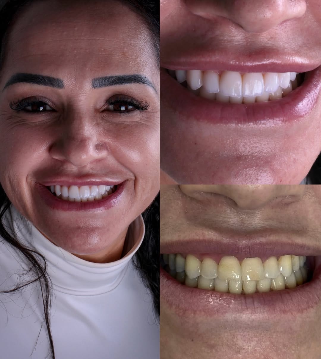 Post 8 by Sheila Amaral-Harmonização Facial | Lentes de Contato Dental on Instagram (carousel)