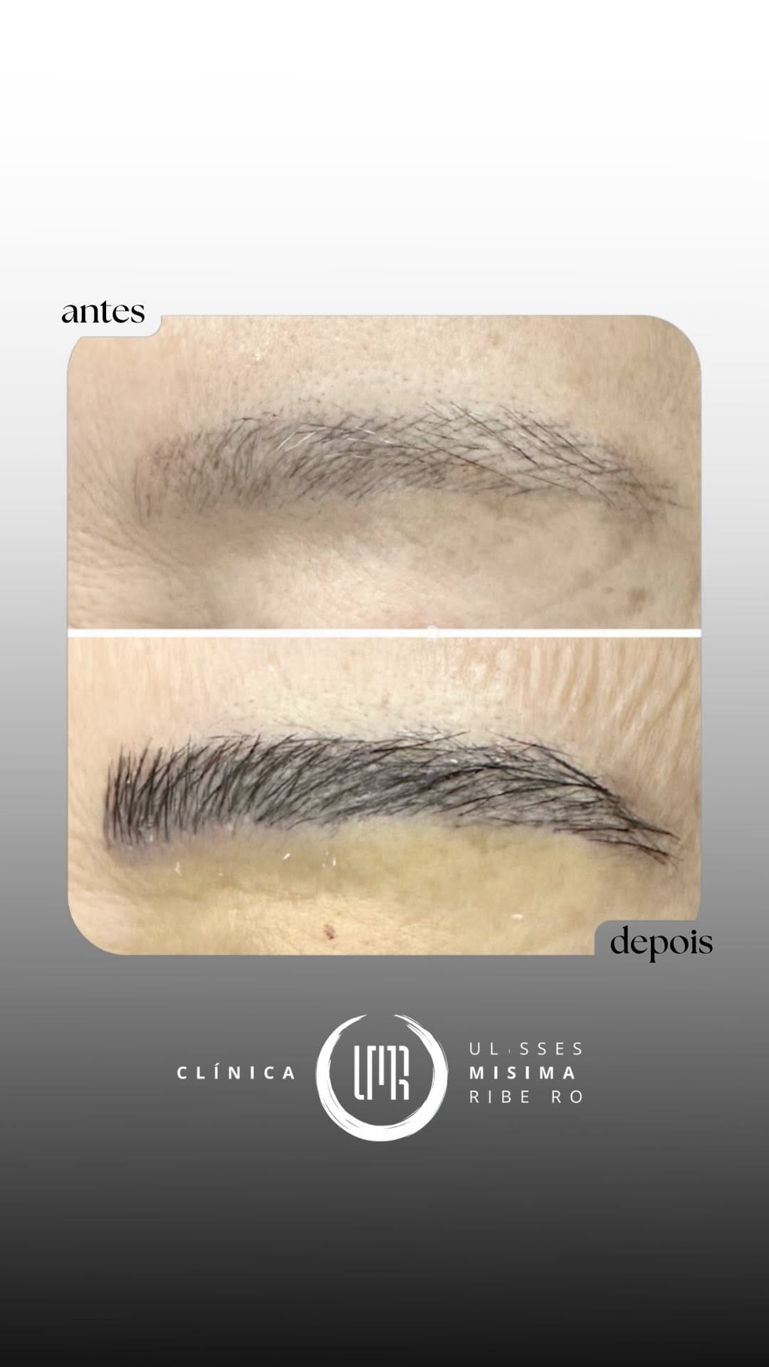 Post 8 by Dr. Ulisses Misima Ribeiro | CRM17898 RQE12487 on Instagram (video)