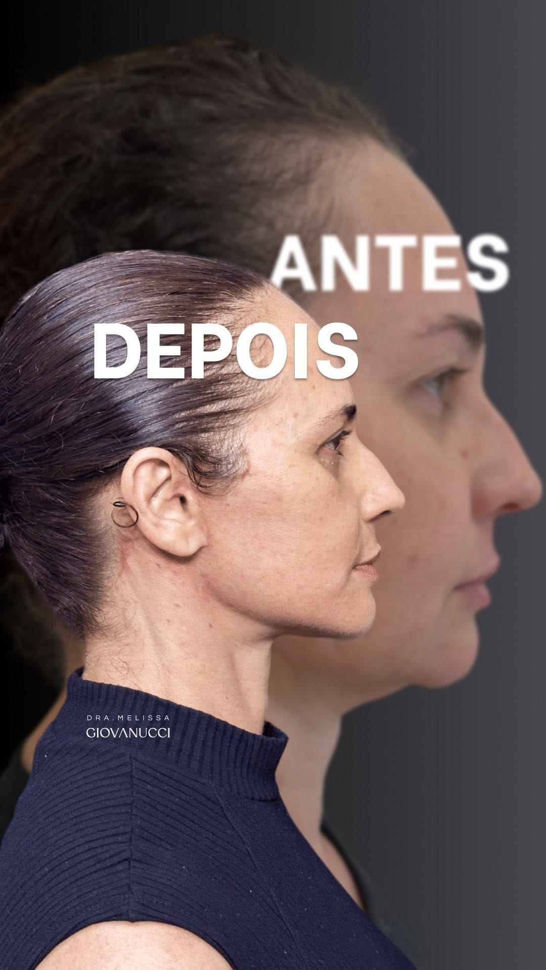 Post 9 by Dra Melissa Giovanucci | Cirurgiã Plástica & Cosmiatria on Instagram (video)
