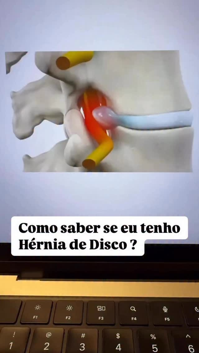 Post 1 by Dr. Vinício Nunes - Goiânia / Hérnia de Disco / Escoliose on Instagram (video)