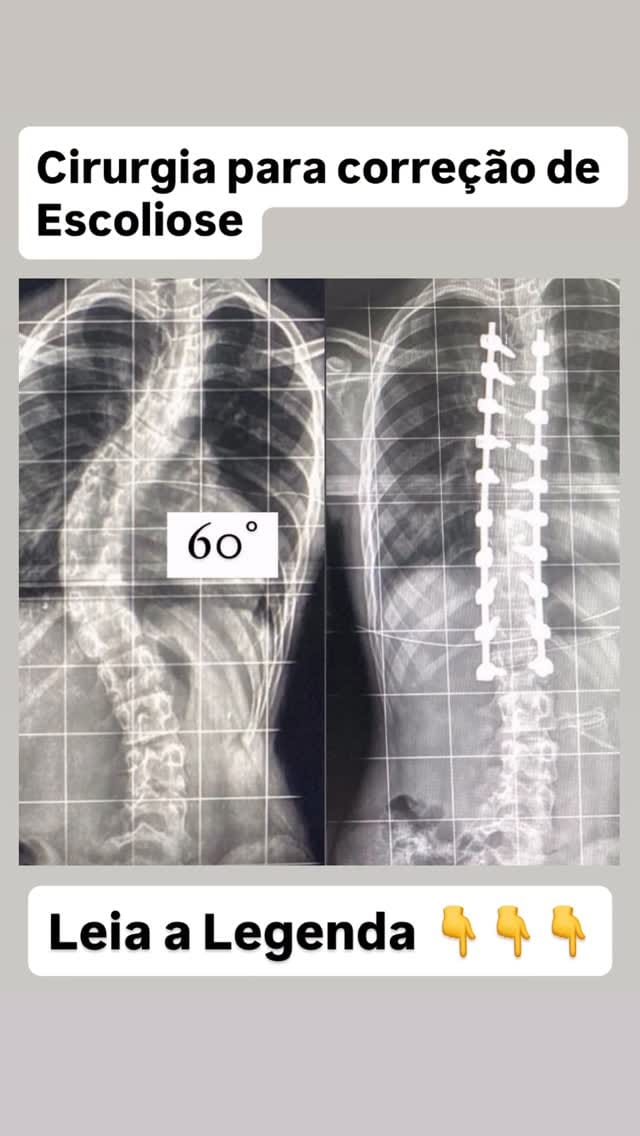 Post 5 by Dr. Vinício Nunes - Goiânia / Hérnia de Disco / Escoliose on Instagram (video)