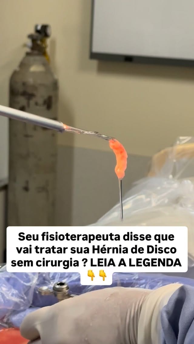 Post 7 by Dr. Vinício Nunes - Goiânia / Hérnia de Disco / Escoliose on Instagram (video)